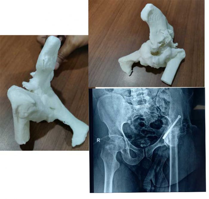 Yemen blast victim regains ability to walk with the help of 3D printing technology at Aster RV Hospital
