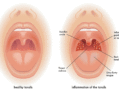 Why Tonsillitis Peaks in Winter and How to Prevent It