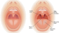 Why Tonsillitis Peaks in Winter and How to Prevent It