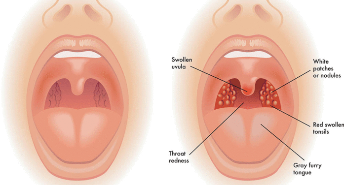 Why Tonsillitis Peaks in Winter and How to Prevent It