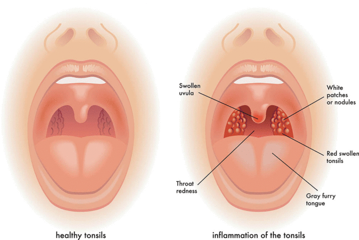 Why Tonsillitis Peaks in Winter and How to Prevent It